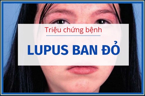 Các triệu chứng bệnh lupus ban đỏ là gì? Tìm hiểu ngay!